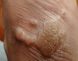 Набор с ножом для отслоения бородавок (2)