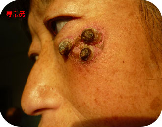 Набор с ножом для отслоения бородавок (3)